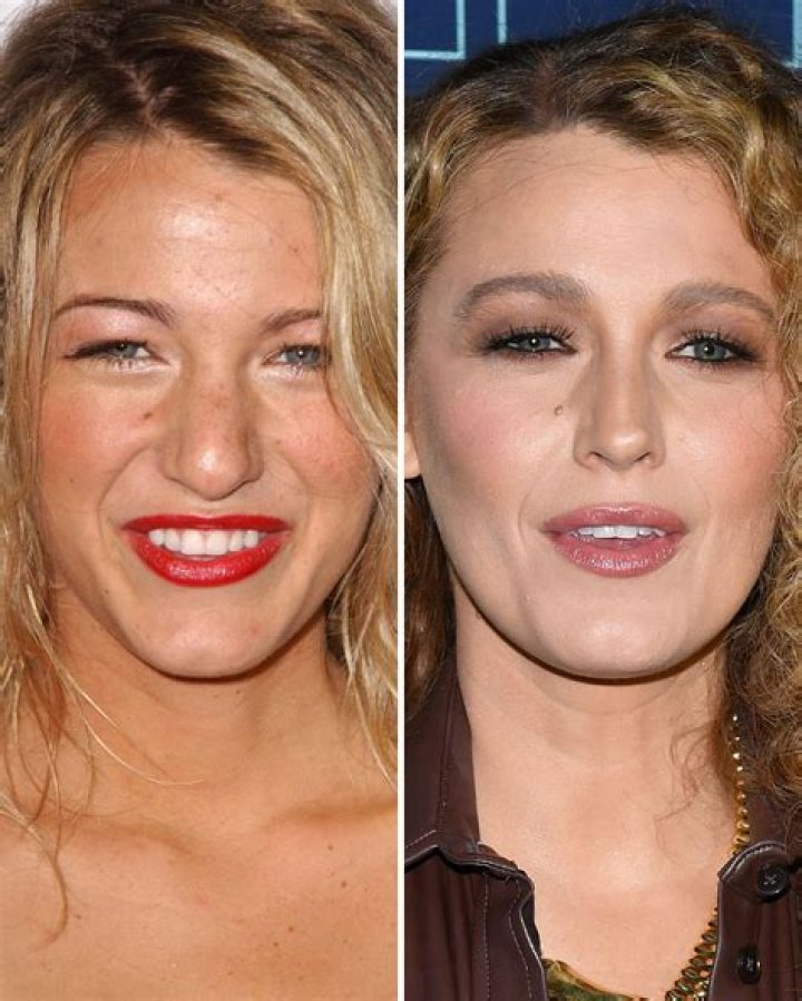 Blake Lively Plastic Surgery Before and After
