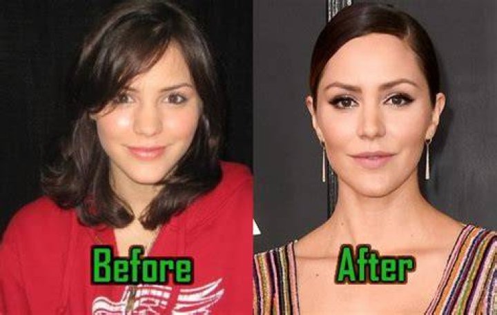 Katharine McPhee Breast Augmentation Plastic Surgery Before and After