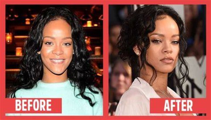Rihanna Breast Implants Plastic Surgery Before and After